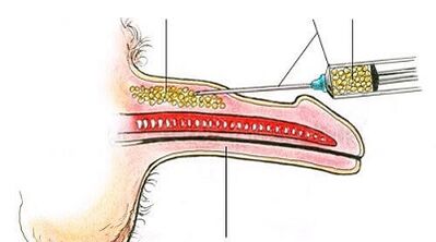 Surgical method of increasing the member